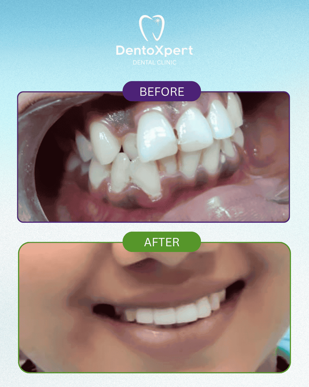 Before and after dental treatment result at DentoXpert Dental Clinic in Thane